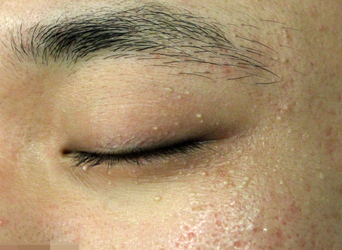 눈가 비립종