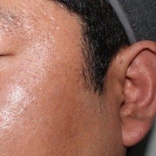 얼굴 편평사마귀·검버섯·피지선증식증 치료 후